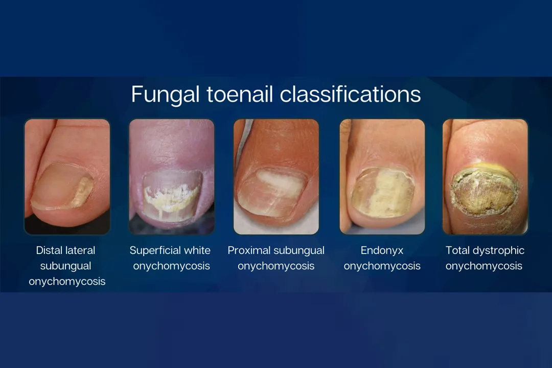 Understanding And Treating Toenail Fungus Stepping Stone Understanding And Treating Toenail Fungus Stepping Stone